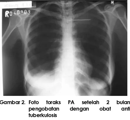 Gambar 1. Foto toraks PA dan lateral sewaktu dikonsul ke bagian paru 