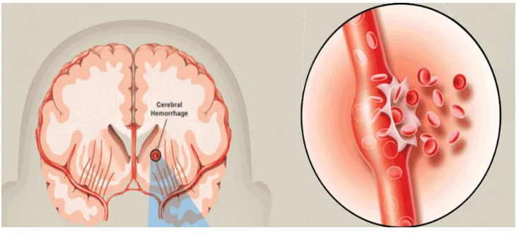 Gambar. 9. 2. Stroke Hemorrhage