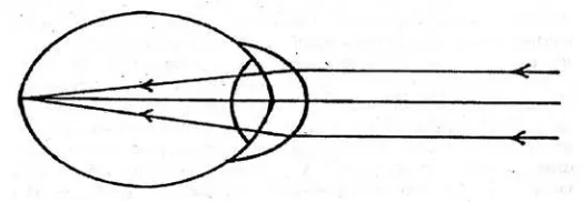 Gambar 2.2. Kelainan Mata Hipermetropi(Sumber : Ilyas, 2003) 