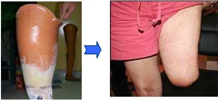 Gambar 1. Socket Prosthesis dan Stump [2]  