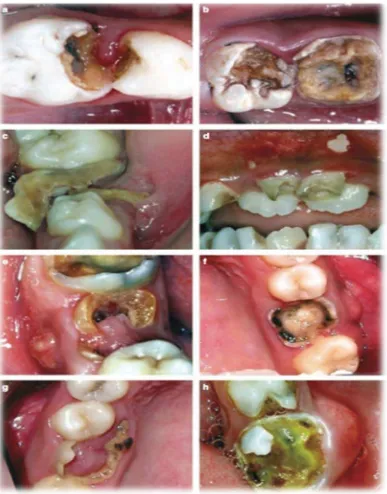 Gambar 2. Gambaran klinis gigi akibat karies yang tidak dirawat. (a dan b) Keterlibatan pulpa P/p, kamar pulpa terlihat atau koronal gigi telat   hancur  oleh proses karies dan hanya akar atau sisa akar yang tertinggal;  (c dan d) Ulserasi U/u, traumatik ulser pada jaringan lunak( lidah dan mukosa) karena gigi atau sisa akar;  (e dan f) Fistula F/f, saluran sinus mengeluarkan nanah;  (g dan h) dento-alveolar abses.traumatis jaringan lunak sekitarnya, misalnya, lidah atau mukosa bukal1,25 