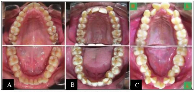 Gambar 1. Derajat keparahan gigi berjejal.20 (A) Gigi berjejal    ringan (B) Gigi berjejal sedang (C) Gigi berjejal berat 