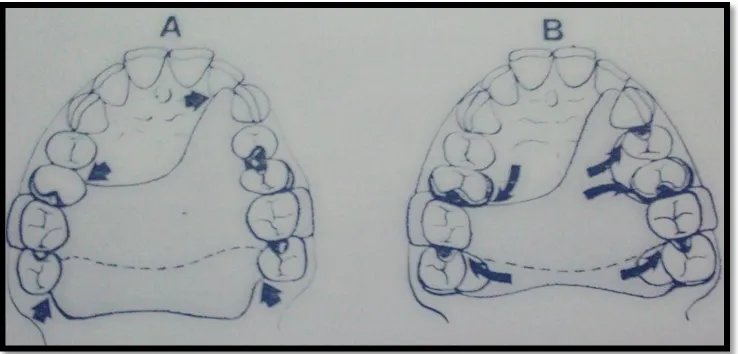 Gambar 3. A Bila basis gigi tiruan berjalan melewati tepi gingiva, sudut antara gigi tiruan  dan tepi gingiva harus tumpul B