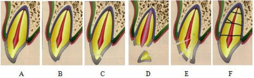 Gambar 1.Kerusakan pada jaringan keras gigi dan pulpa: A. Retak mahkota  B. Fraktur enamelC