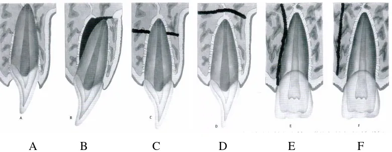 Gambar 3. Kerusakan pada jaringan pendukung:  A. Kerusakan soket alveolar maksila dan mandibula  B