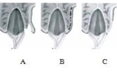 Gambar 4. Kerusakan pada gingiva dan mukosa mulut:  A. Laserasi B. Konkusi C. Abrasi19 
