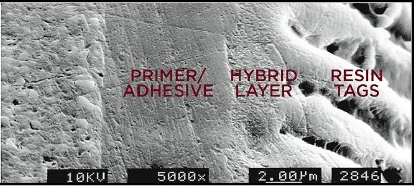 Gambar 6.Hybrid layer membentuk adhesive interface, lapisan ini membentuk  ikatan yang menghubungkan jaringan gigi dan bahan restorasi11 