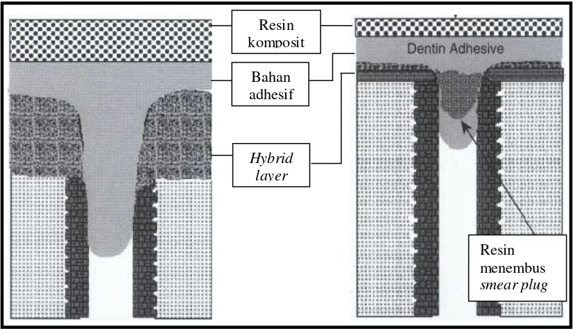 Gambar  7. A. Hybrid layer pada total-etch system, B.Hybrid layer pada self-etch  system6  