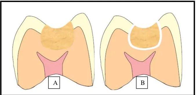 Gambar 2.A. Gigi yang baru direstorasi, sebelum polimerisasi,  B. Pembentukkan marginal gap setelah restorasi.19