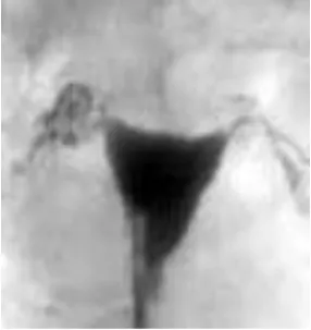 Gambaran HSG dari salpingitis