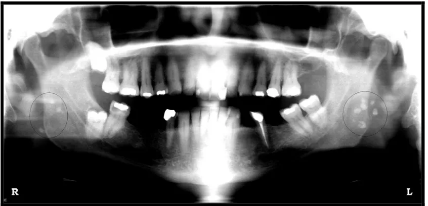 Gambar 4. Gambaran foto panoramik yang menunjukkan adanya tonsillolith multiplekanan dan kiri