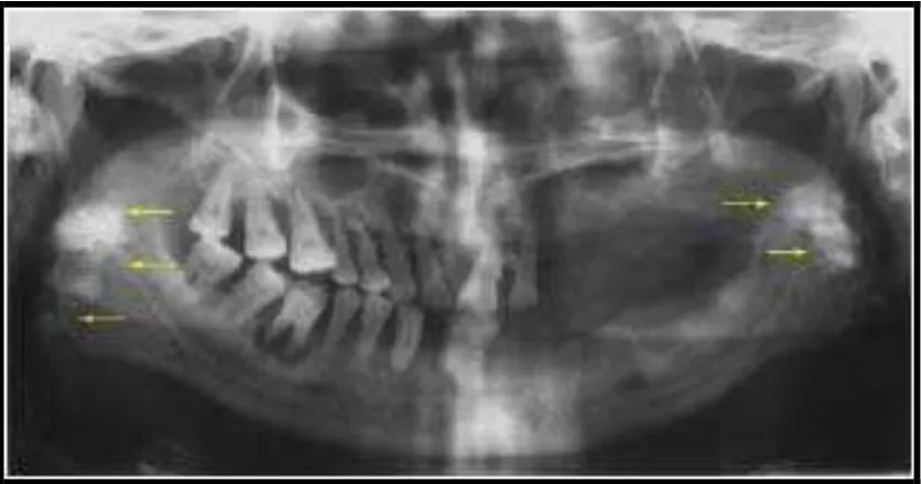 Gambar 6. Gambaran foto panoramik yang menunjukkan massa unilateral dengan gambaran radiopak di pertengahan ramus.20  