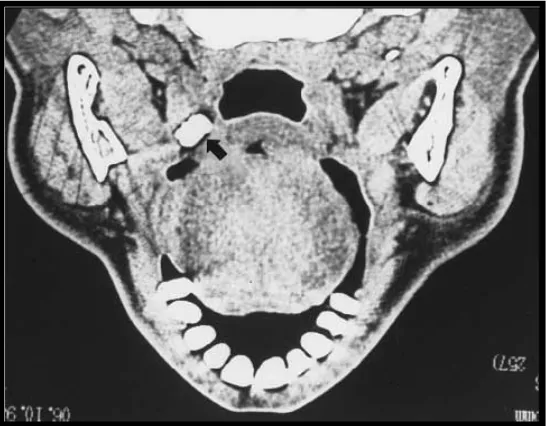 Gambar 9. Gambaran CT scanbilateral. yang menunjukkan massa radiopak 6 