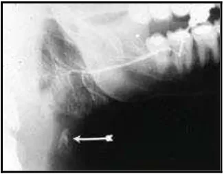 Gambar 11. Gambaran radiografi kalsifikasi kelenjar getah bening (calcified lymph node).20  