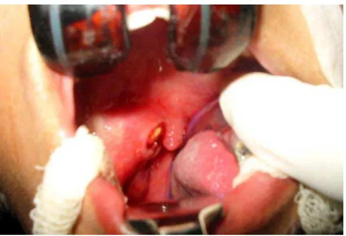 Gambar 14. Gambaran CT scan yang menunjukkan adanya hyperdensityparapharyngeal hingga ramus mandibula