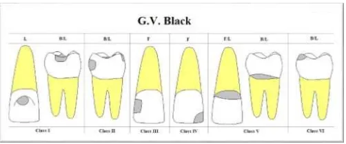 Gambar 4. Klasifikasi karies G.V.Black16 