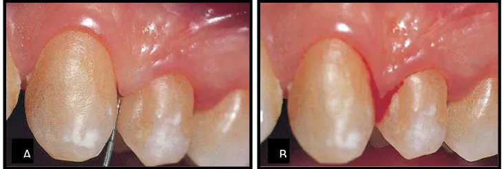 Gambar 3. Tanda inflamasi pada penyakit periodontal. A. Prob dimasukkan   ke dasar poket