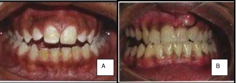 Gambar 9. A) Open Bite Anterior, B) Open Bite Posterior22 