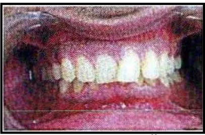 Gambar 10. Deep Bite22 