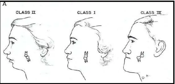 Gambar 5. Klasifikasi Angle klas I, Klas II, dan Klas III30 