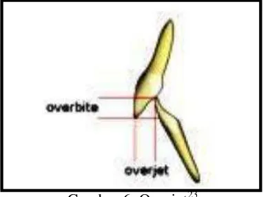 Gambar 7. Crossbite Anterior23 