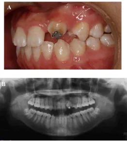 Gambar 17. Foto setelah perawatan.13(A)  Foto intra oral; (B) Foto panoramik 