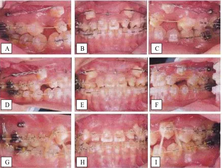 Gambar 23.  Foto intra oral selama perawatan retraksi kaninus.36   (A-C) 3 bulan setelah retraksi kaninus