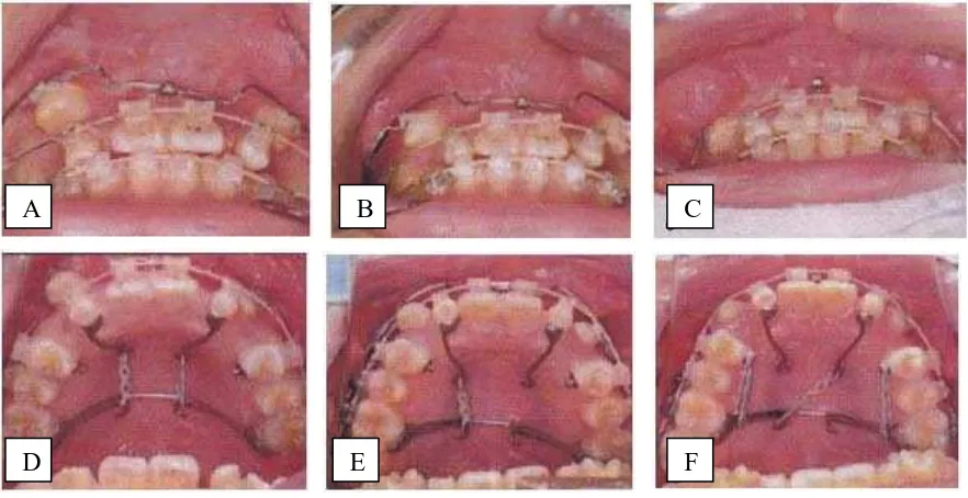 Gambar 24.  Foto intra oral perubahan overjet dan oklusal.36     (A dan D) 3 bulan setelah retraksi kaninus
