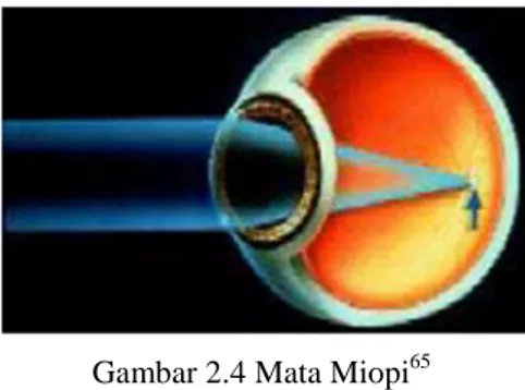 Gambar 2.4 Mata Miopi 65