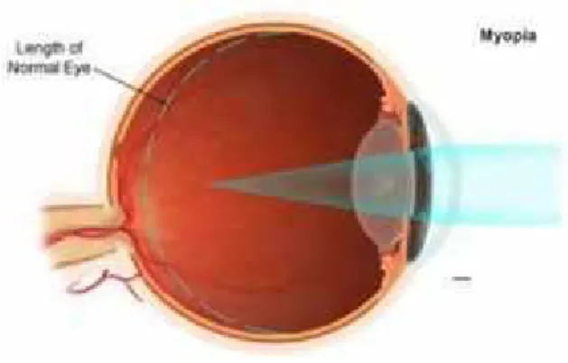 Gambar 3. 4. (a) pada penderita miopibayangan jatuh d depan retina