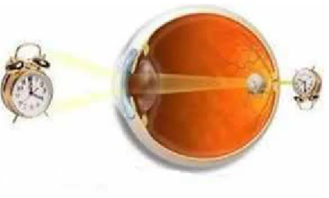 Gambar 3.5. cacat mata hipermetropi, bayangan benda jatuh di belakang retina