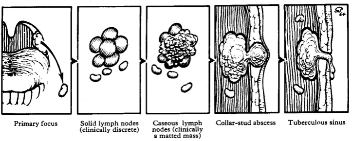 Gambar 2.2.Patogenesis limfadenitis TB.15 