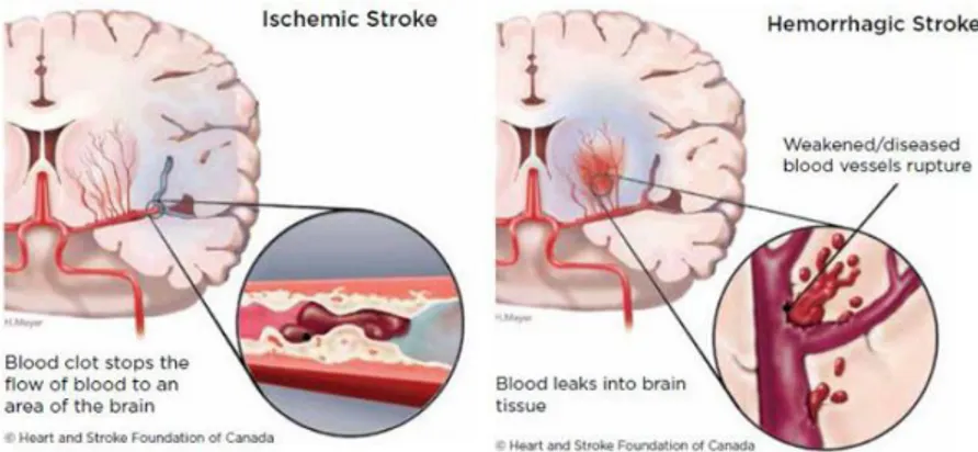 Gambar 2.1 Klasifikasi Stroke (Heart and Stroke Foundation of Canada, 2016)