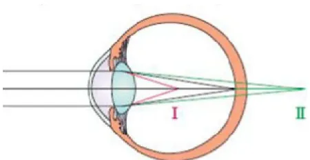 Gambar 2.3. Titik fokus pada mata emetropia (garis hitam) dan mata  