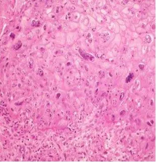 Gambar 2.1. Karsinoma Nasofaring Keratinizing Squamous Cell Carcinoma 