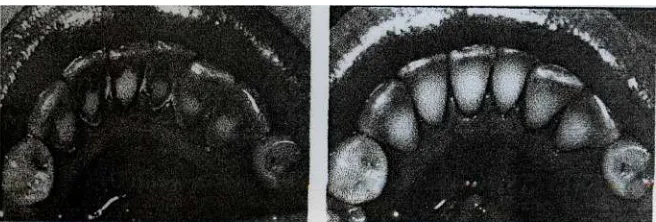 Gambar 3.3 - Sebelum dan sesudah dilakukan pembersihan karang gigi 