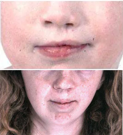 Gambar 1. Gambaran facial celah bibir dan celah palatum.14 