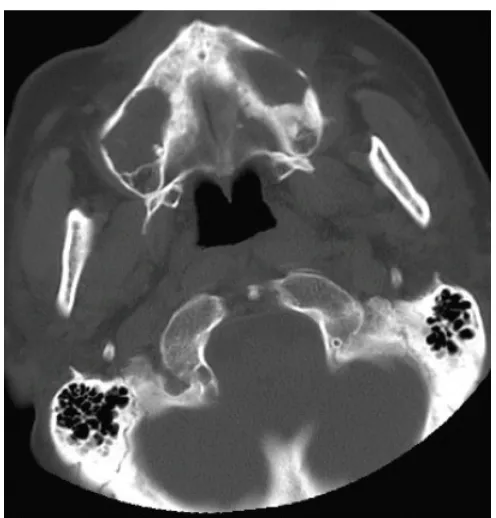 Gambar  8. Radiografi panoramik menunjukkan gambaran radiolusen beberapa lesi  odontogenik keratosis.2 