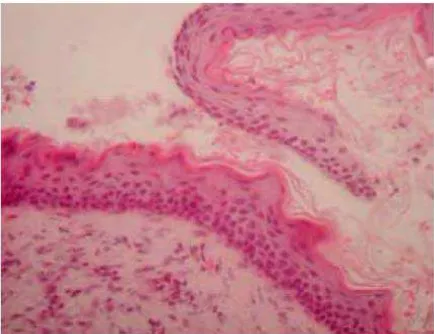 Gambar 11.Karakteristik aspek hitopatologi dari keratinized epithelium dari odontogenik keratosis.2 