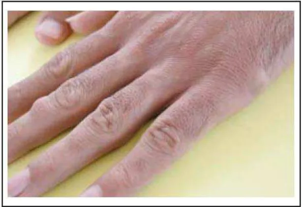 Gambar 13. Kista epidermis pada tangan pasien.7