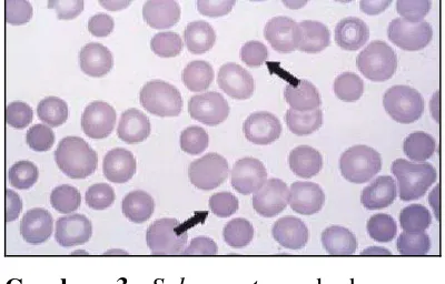 Gambar 3. Spherocyte pada hapusan darah tepi.11 
