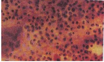 Gambar 2.3. Sitologi ulkus disebabkan oleh mastitis kronik Kistik Payudara    