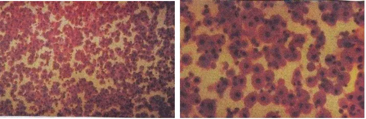 Gambar 2.4. Sitologi Displasia Kistik Payudar  