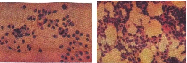 Gambar 2.8. Sitologi karsinoma lobuler invasive payudara  