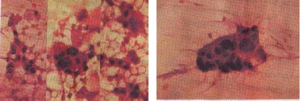Gambar 2.9. Sitologi karsinoma papiler payudara 