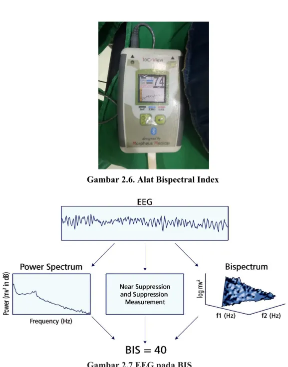 Gambar 2.6. Alat Bispectral Index 