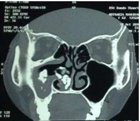 Gambar 1. Pemeriksaan CT-Scan Sinus paranasal 