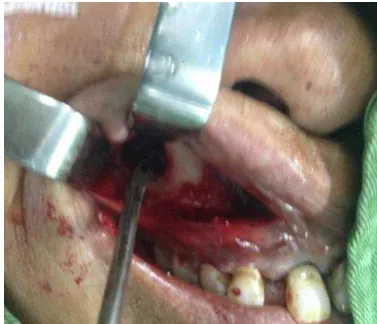 Gambar 2. Rhinolith di keluarkan dengan 