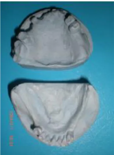 Gambar 4. Diagnostic wax model rahang atas 