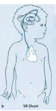 Gambar 2.6 Pemasangan ventriculoarterial shunt. (Dikutip dari : Cathy C. Cartwright and Donna C